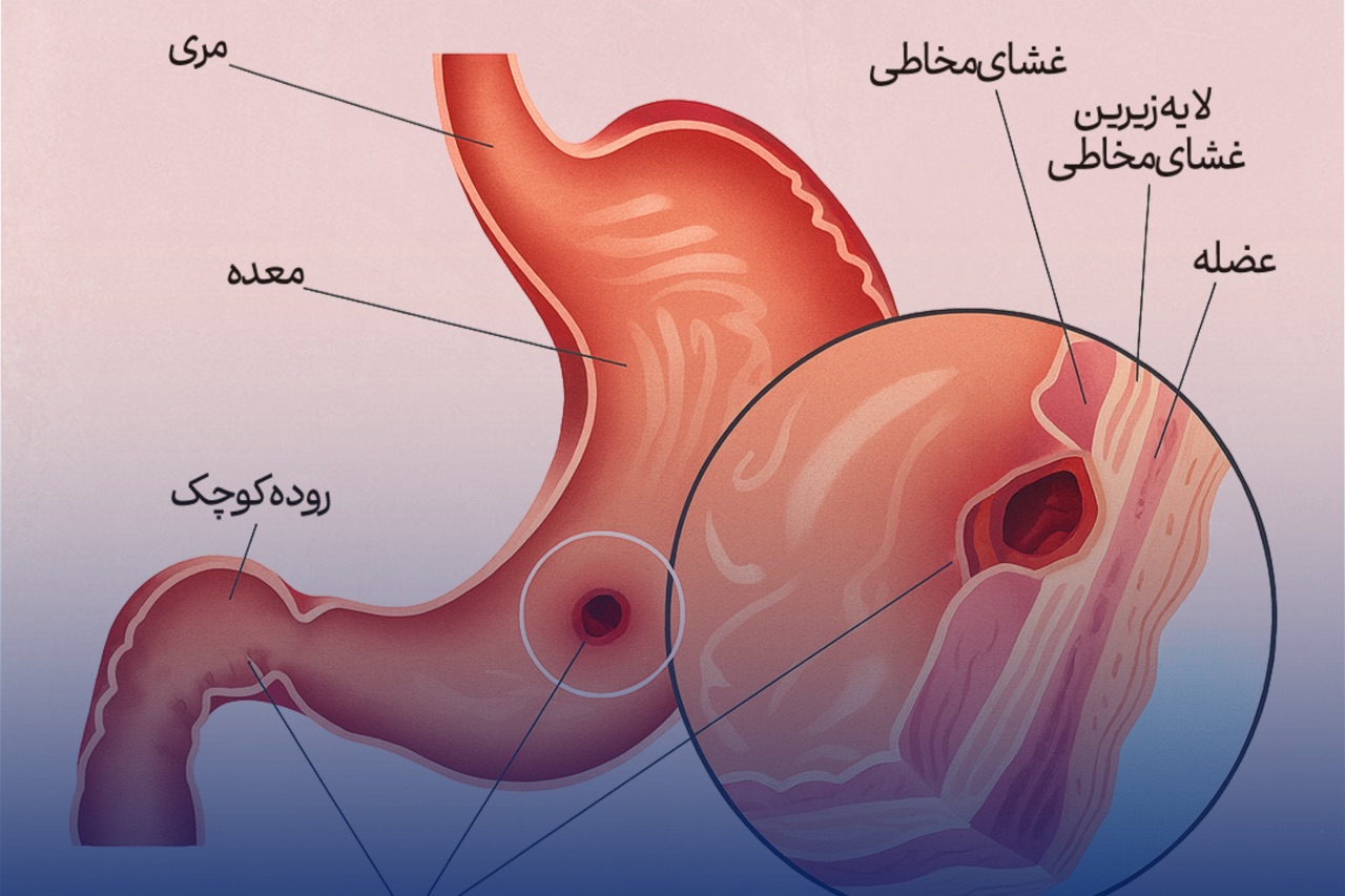 زخم معده چیست؟